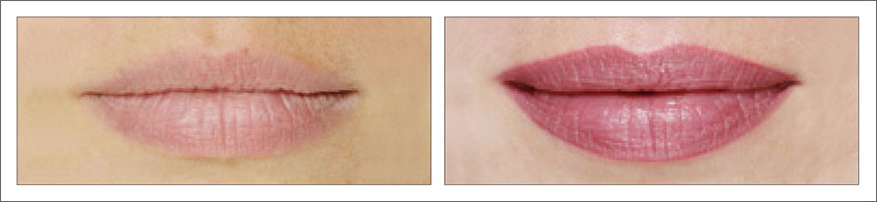 lips-before-and-after